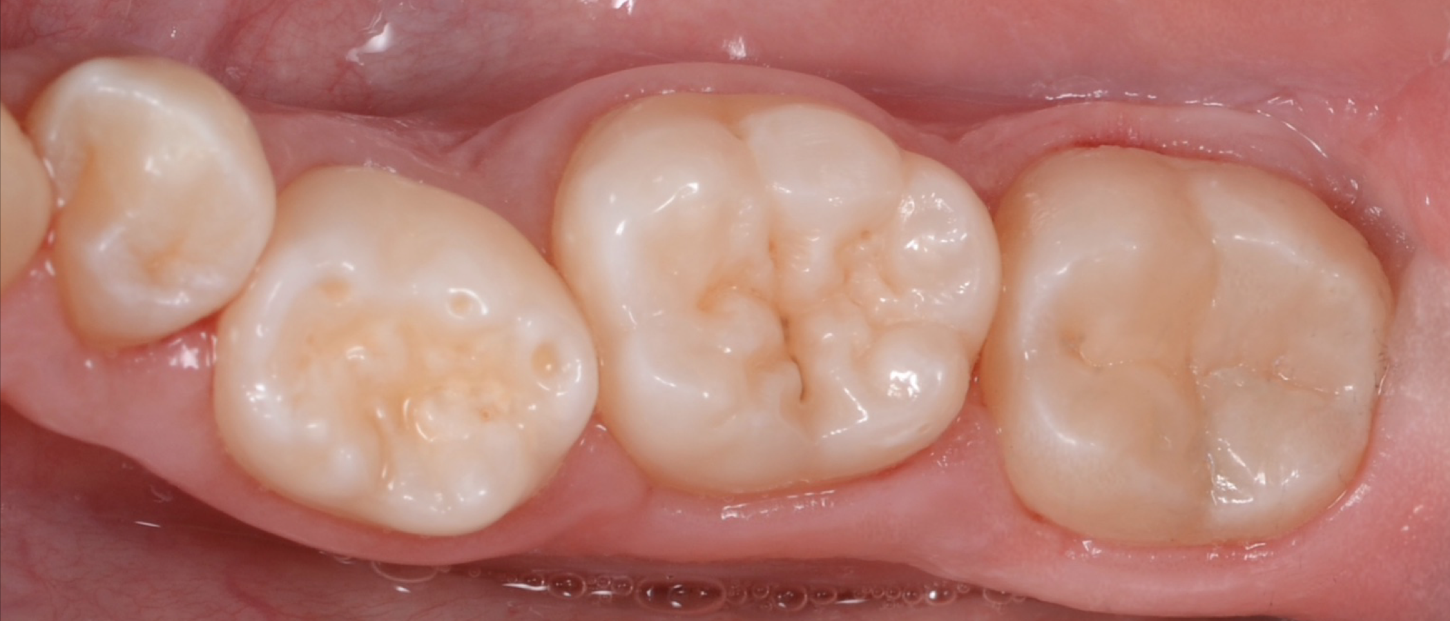 Final result after occlusal adjustment and polish
