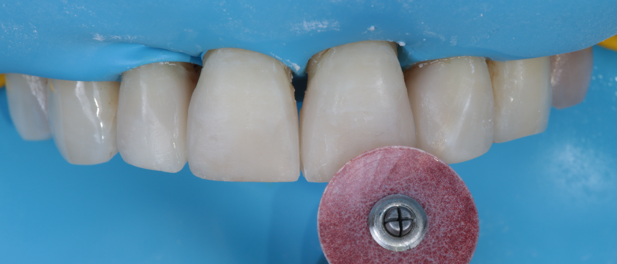 3M™ Sof-Lex™ XT Discs are used to finish the restorations, removing gross excess and defining embrasures and line angles