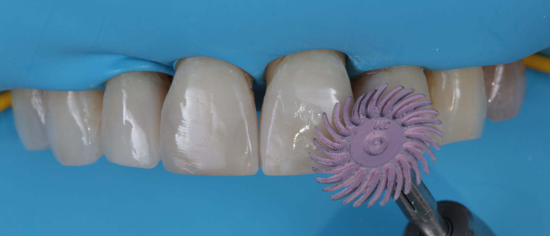 A high-gloss finish is achieved using 3M™ Sof-Lex™ Diamond Polishing Spirals