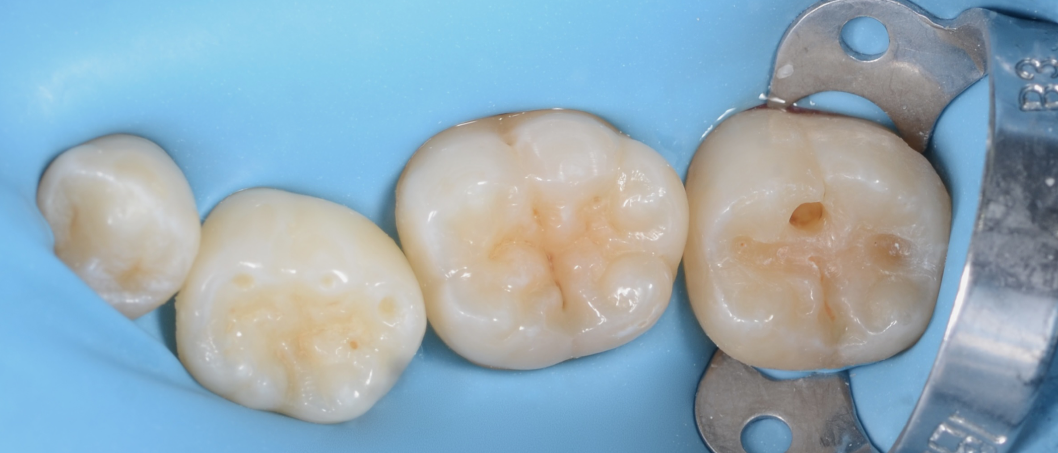 After rubber dam isolation and minimally-invasive preparation, the tooth is ready for adhesion