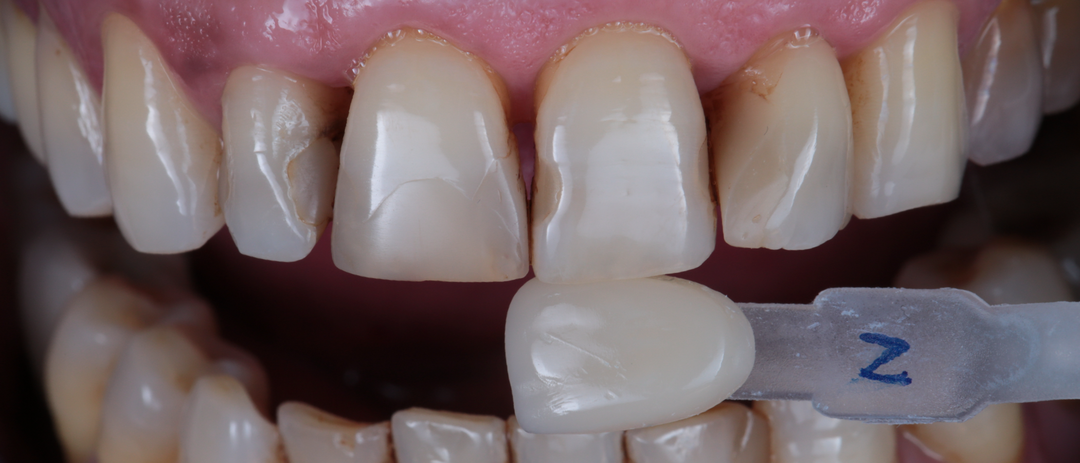 Using a custom shade guide, shade was matched to Natural, before placing a rubber dam