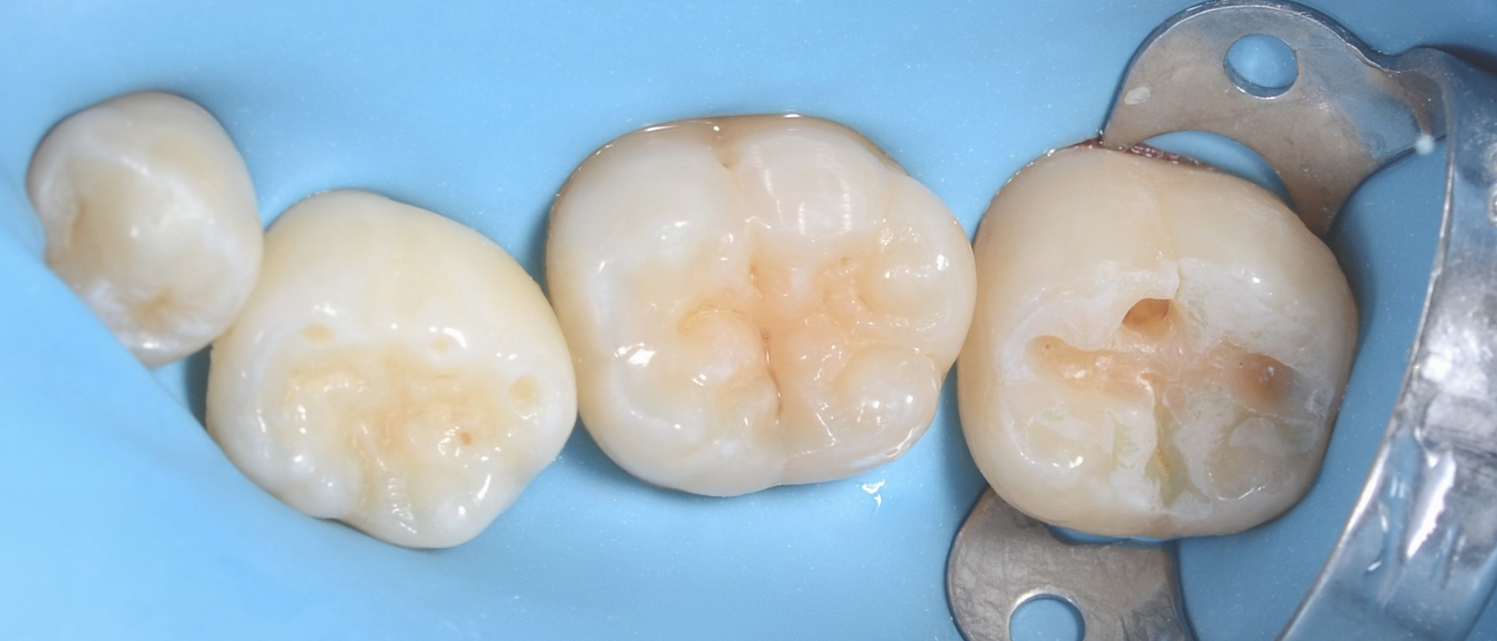 Phosphoric acid is used to selectively etch the enamel, and is rinsed off, leaving a chalky, etched appearance