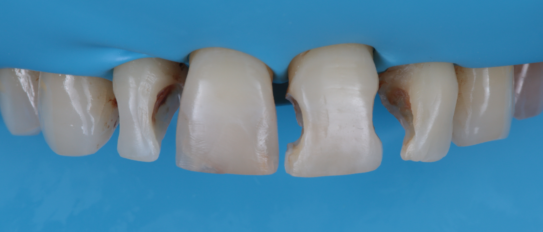 Restorations were removed, and bevels were placed in the enamel. The Class III preparations involve the buccal aspect
