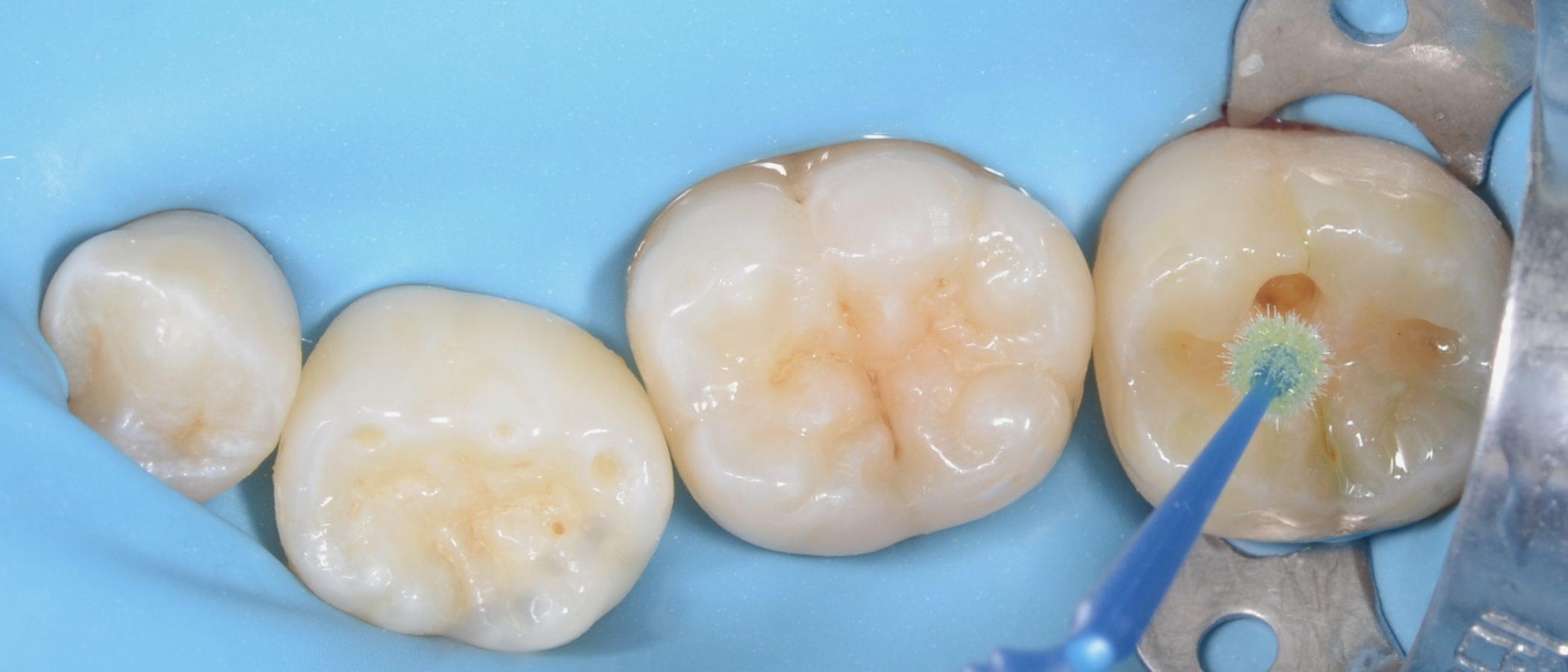 3M™ Scotchbond™ Universal Plus Adhesive is applied to the preparation for 20 seconds, on both enamel and dentin, dried and cured