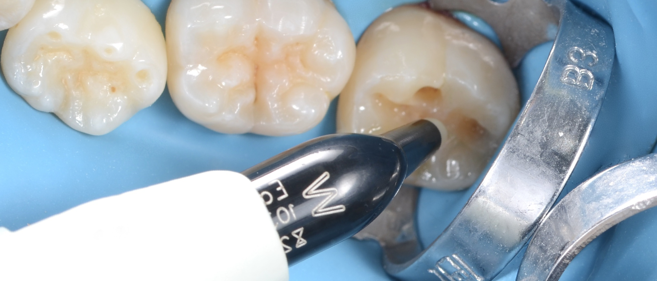 3M™ Filtek™ Easy Match Universal Restorative, Warm shade is applied to the cavity preparation in increments of 2 mm