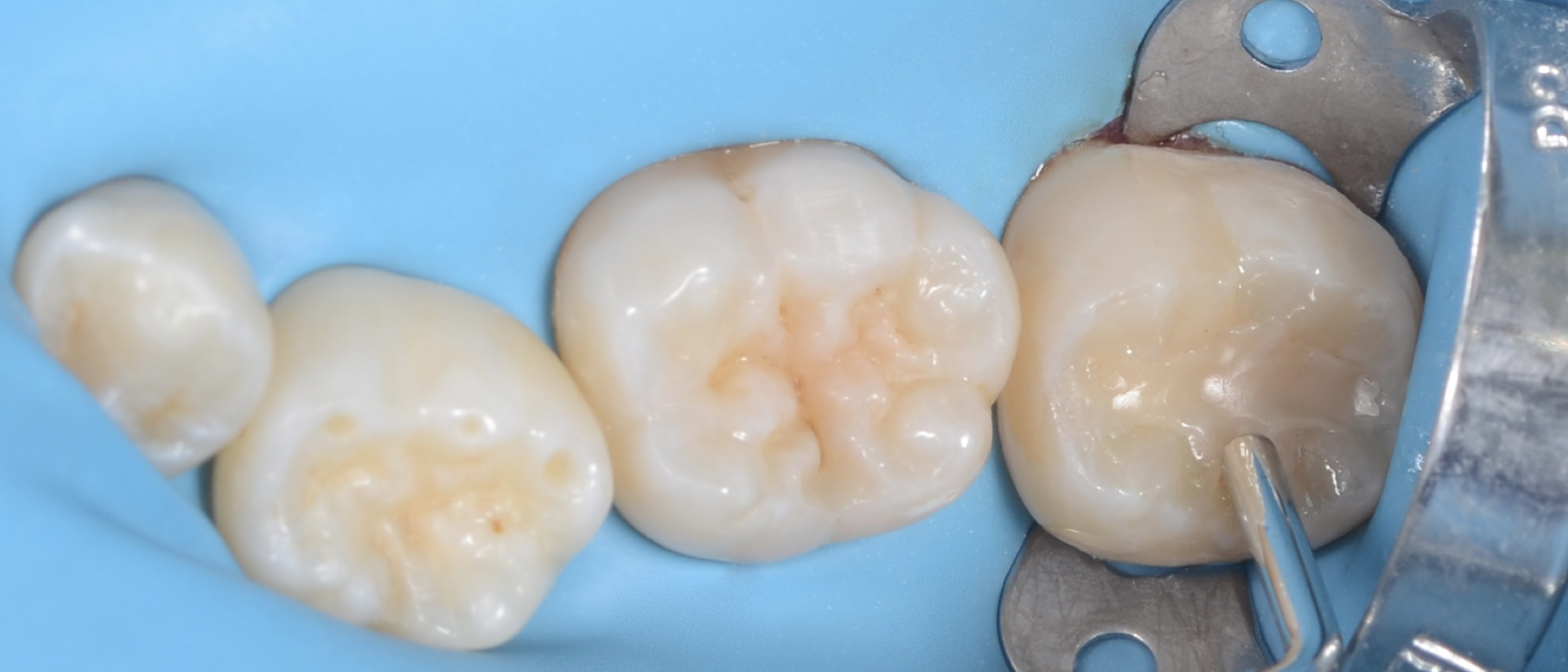 Composite instruments are used to model the material and remove excess