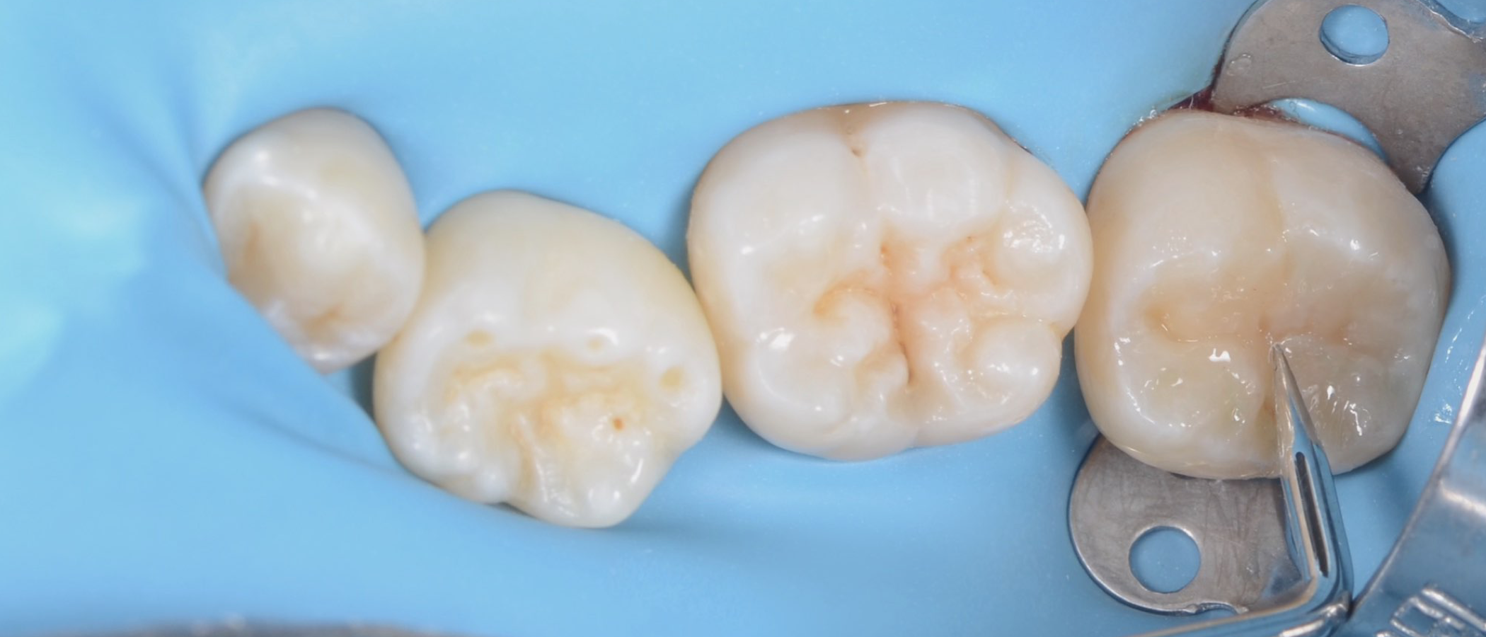 Anatomical fissures are refined and highlighted for a natural look and function