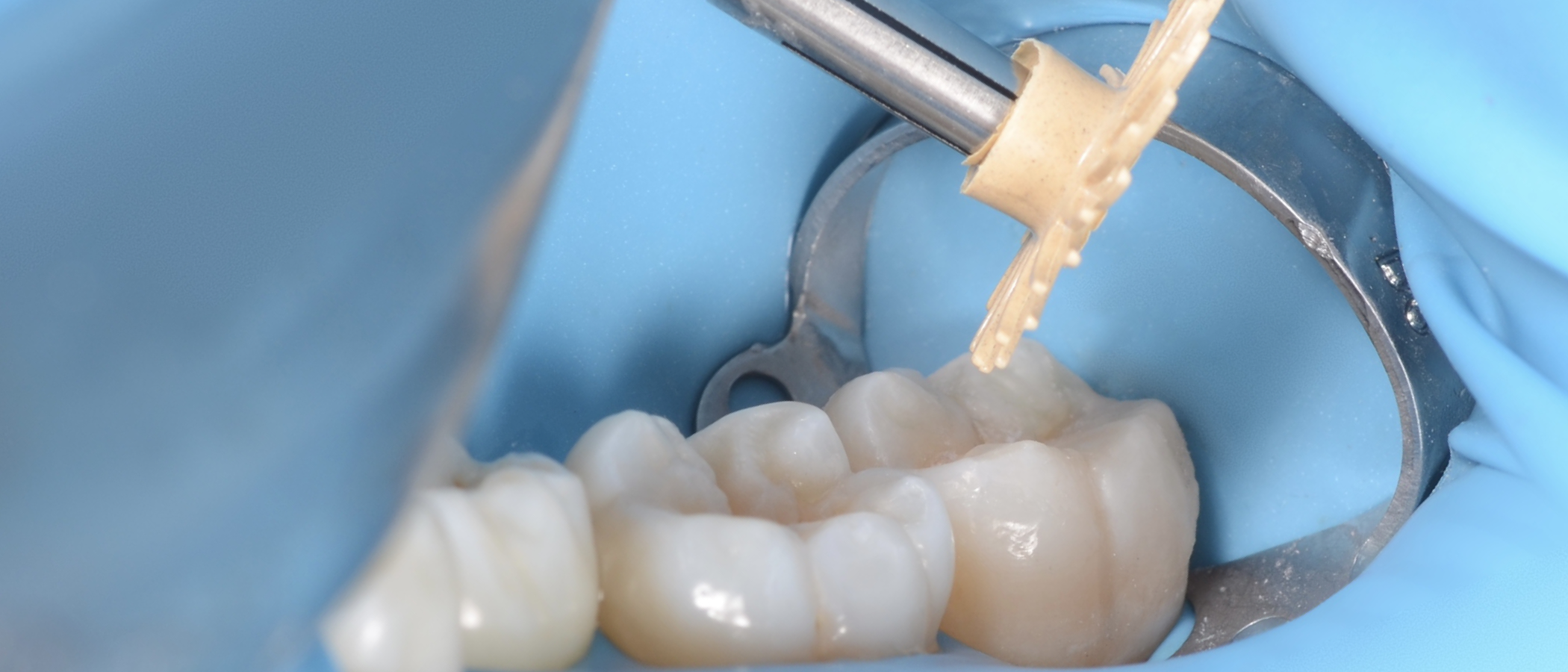 3M™ Sof-Lex™ Pre-Polishing Spirals are used to finish the restoration, even on the occlusal surface