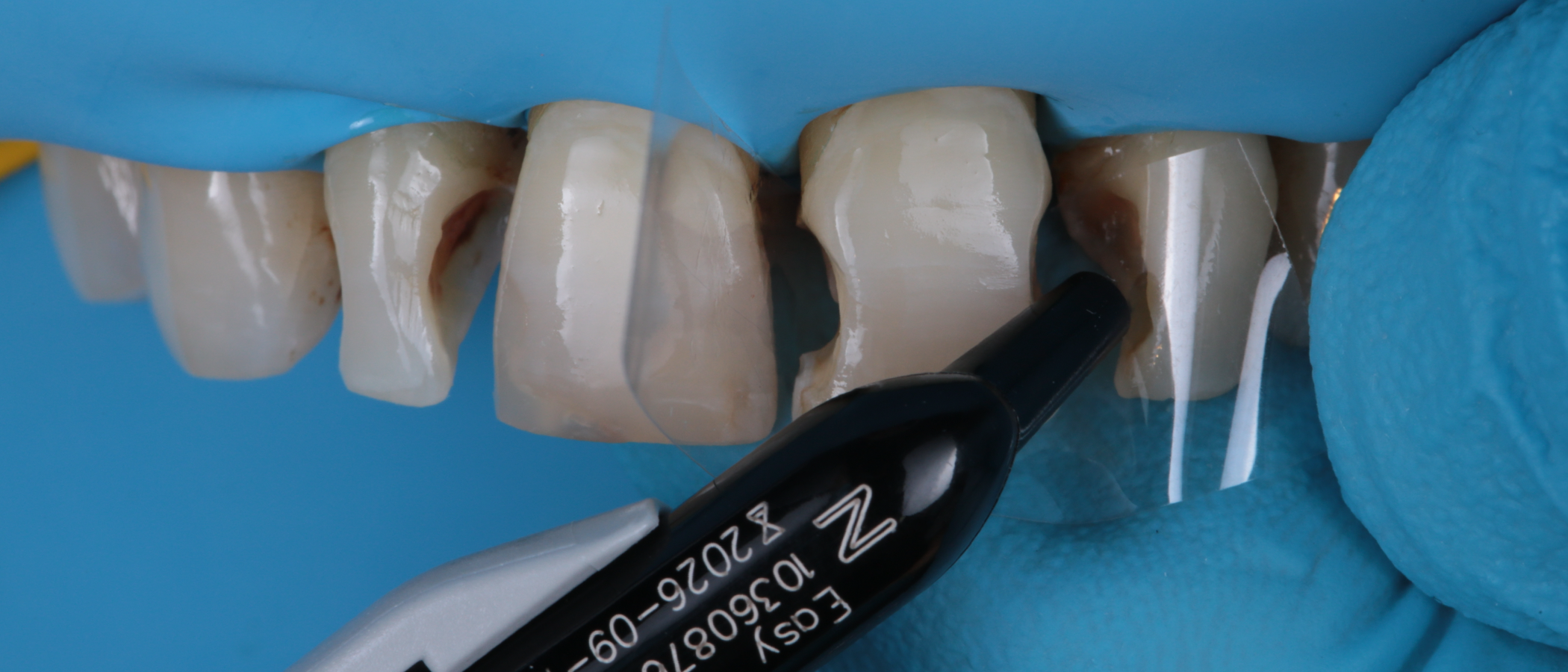 Using mylar strips, 3M™ Filtek™ Easy Match Universal Restorative, Natural shade is placed in the preparations, and cured in 2 mm increments