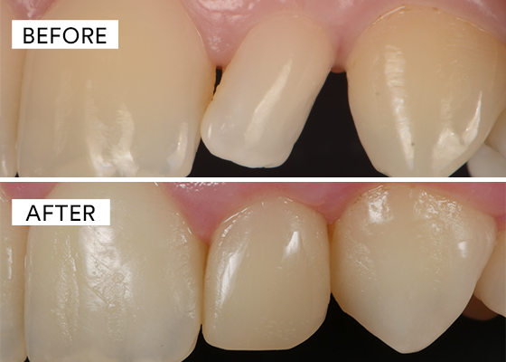 before and after