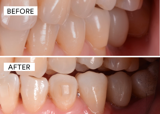 before and after