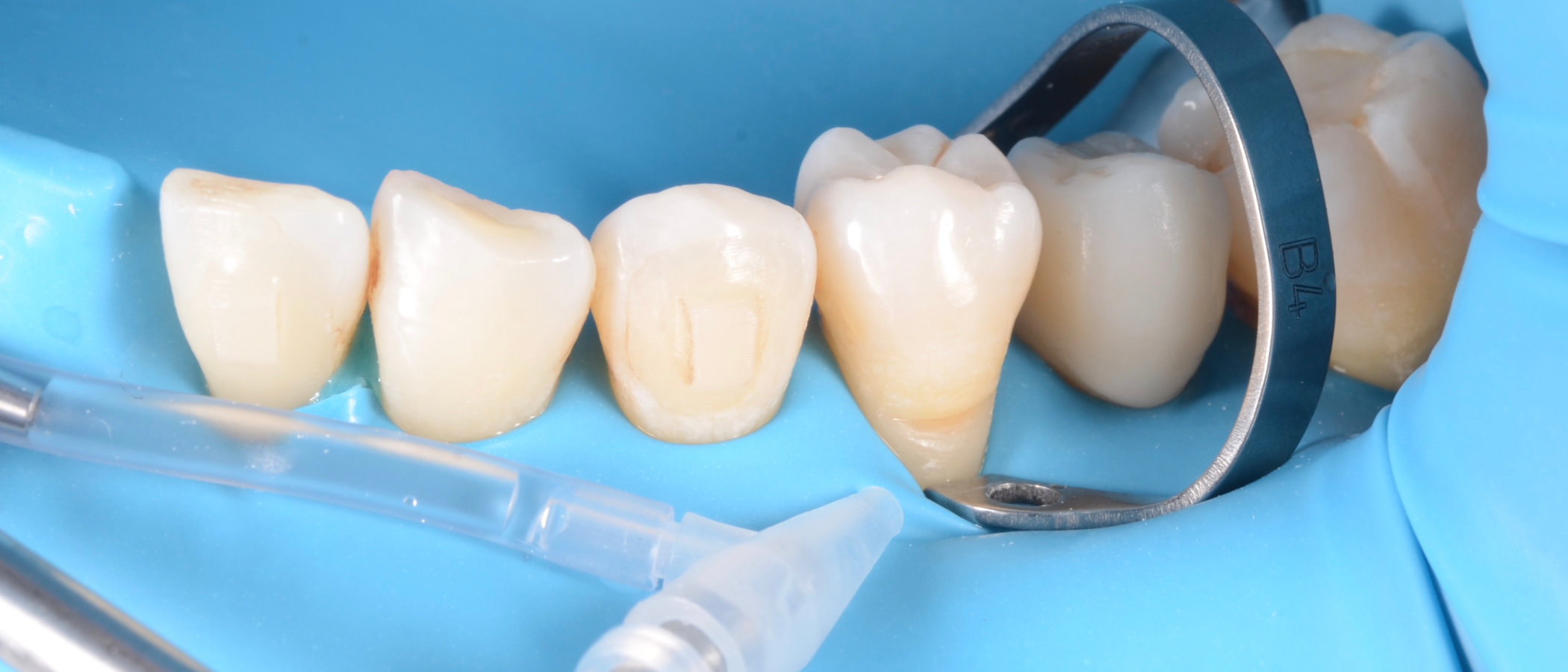 Rubber dam isolation and adequate retraction are key to success in treating NCCL. Plaque and debris are removed with sodium bicarbonate air — powder polishing