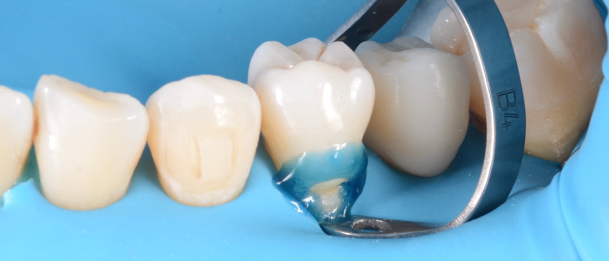 Phosphoric acid is used to selectively etch the enamel, to enhance retention