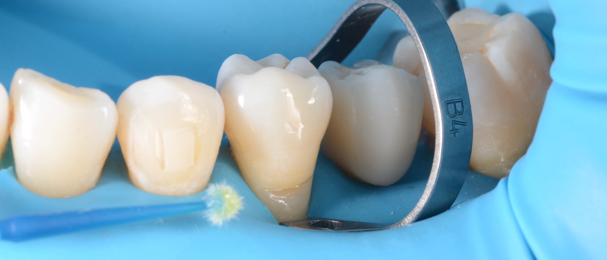 3M™ Scotchbond™ Universal Plus Adhesive is applied to the preparation for 20 seconds, on both enamel and dentin, dried and cured