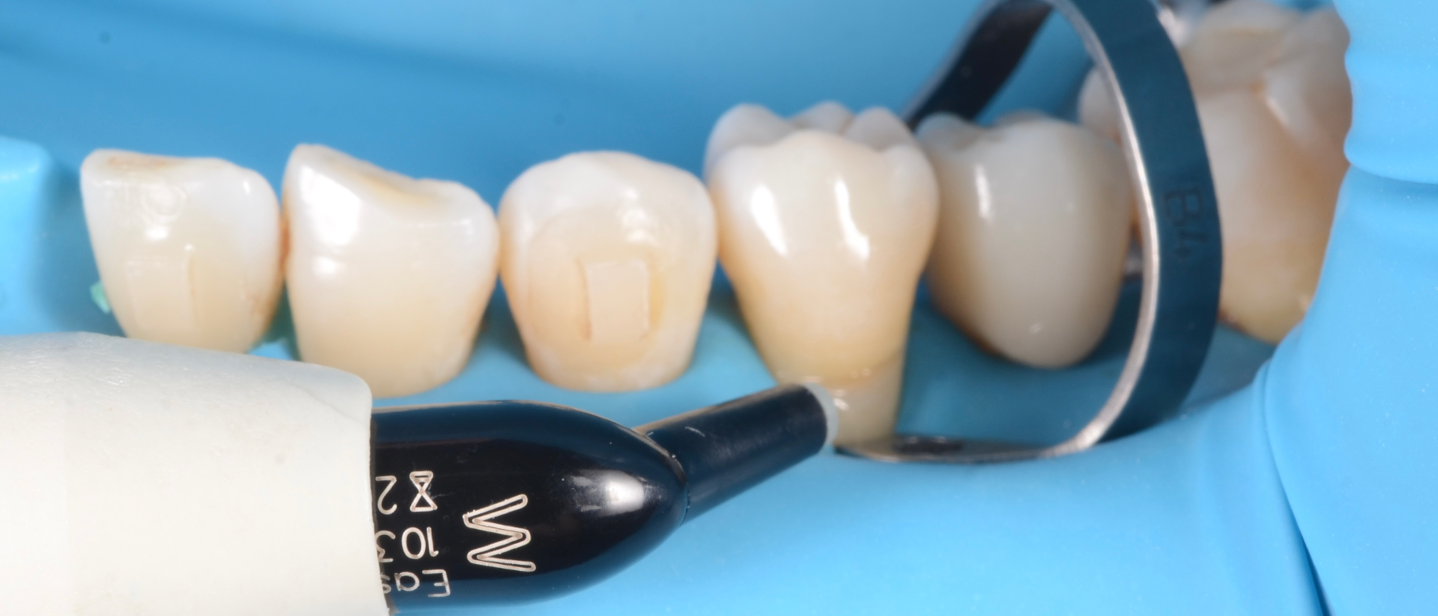 Application of 3M™ Filtek™ Easy Match Universal Restorative, Warm shade
