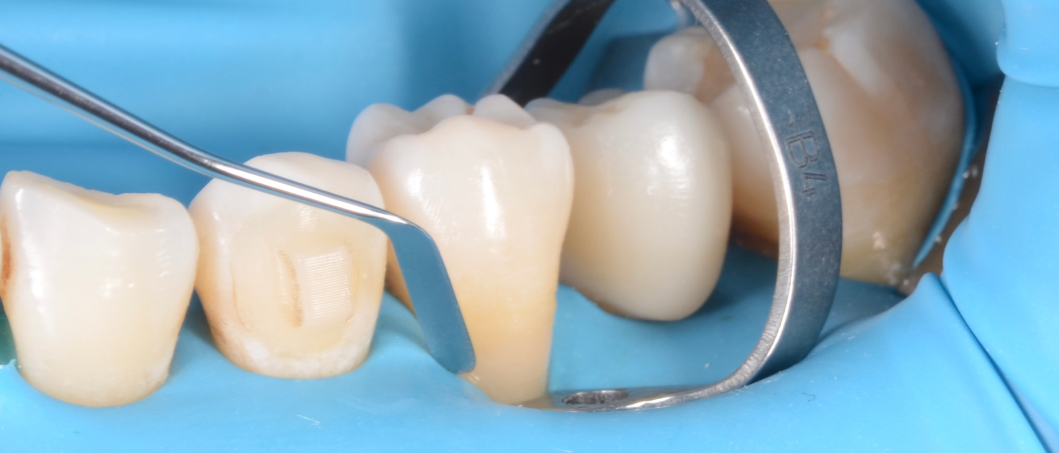 A composite instrument is used to shape Filtek Easy Match Universal Restorative
