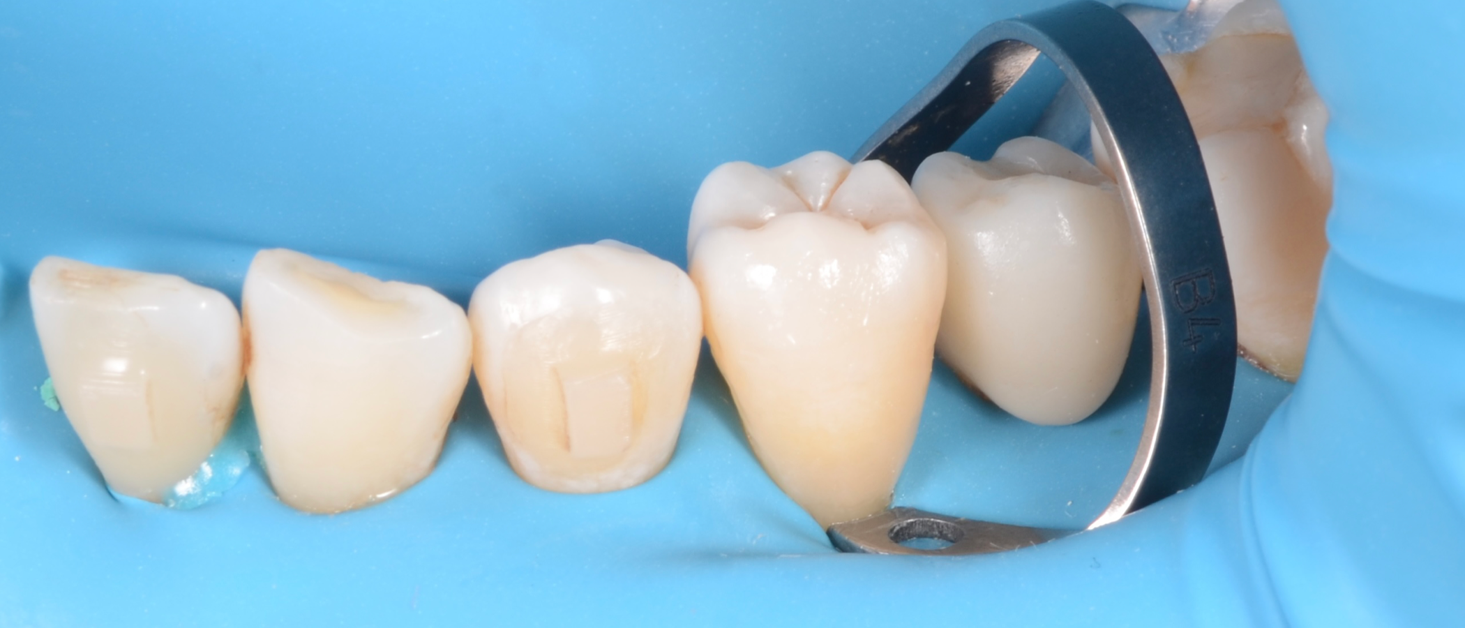 Contour before finishing and polishing. Note the smooth transition between the tooth and the restoration