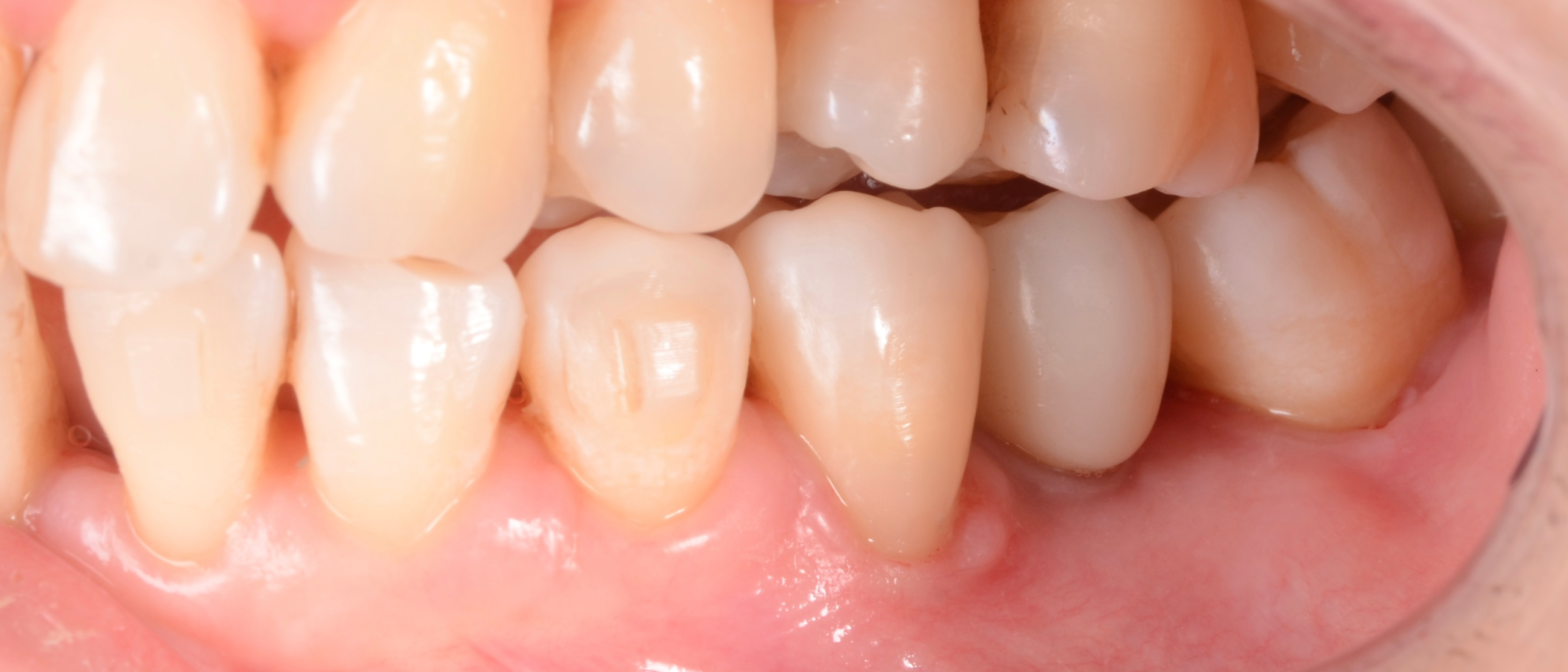 Result after removal of rubber dam. Note the smooth color blend between the restoration and the natural tooth