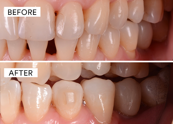 before and after