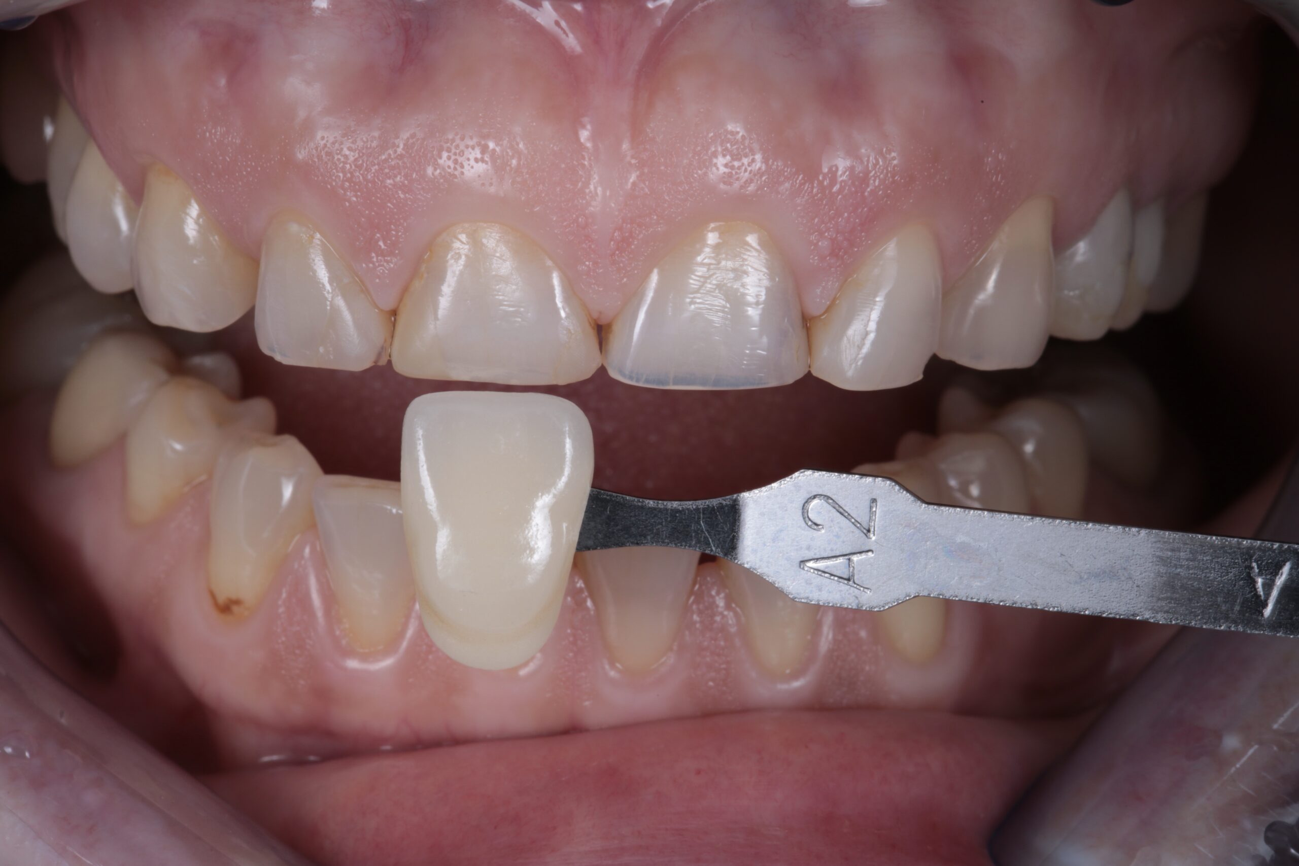 Shade selection. In this case, it was selected 3M Filtek Universal Restorative A2.