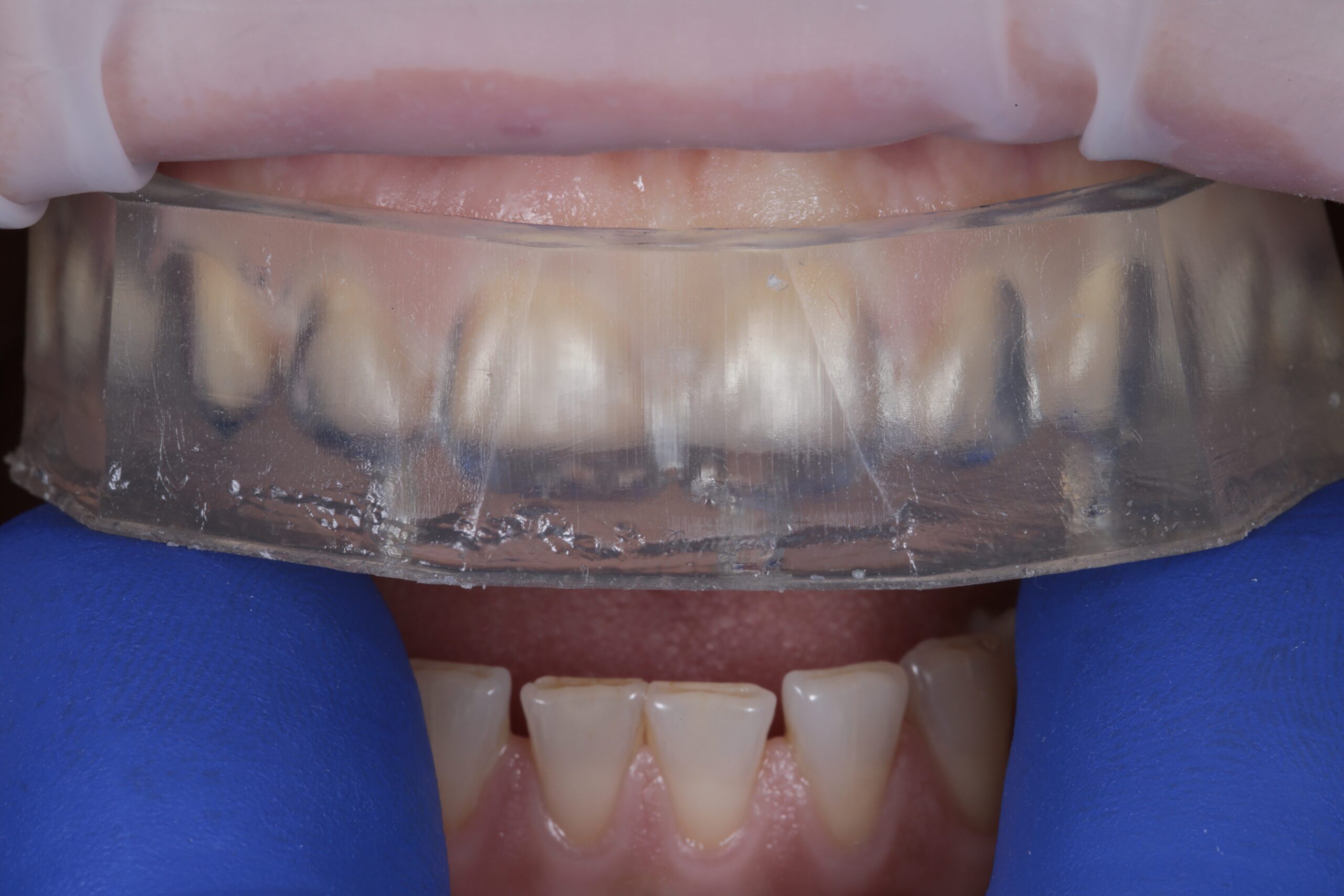 Check the correct fit of the transparent silicone keys. It is recommended to place absolute or relative isolation.