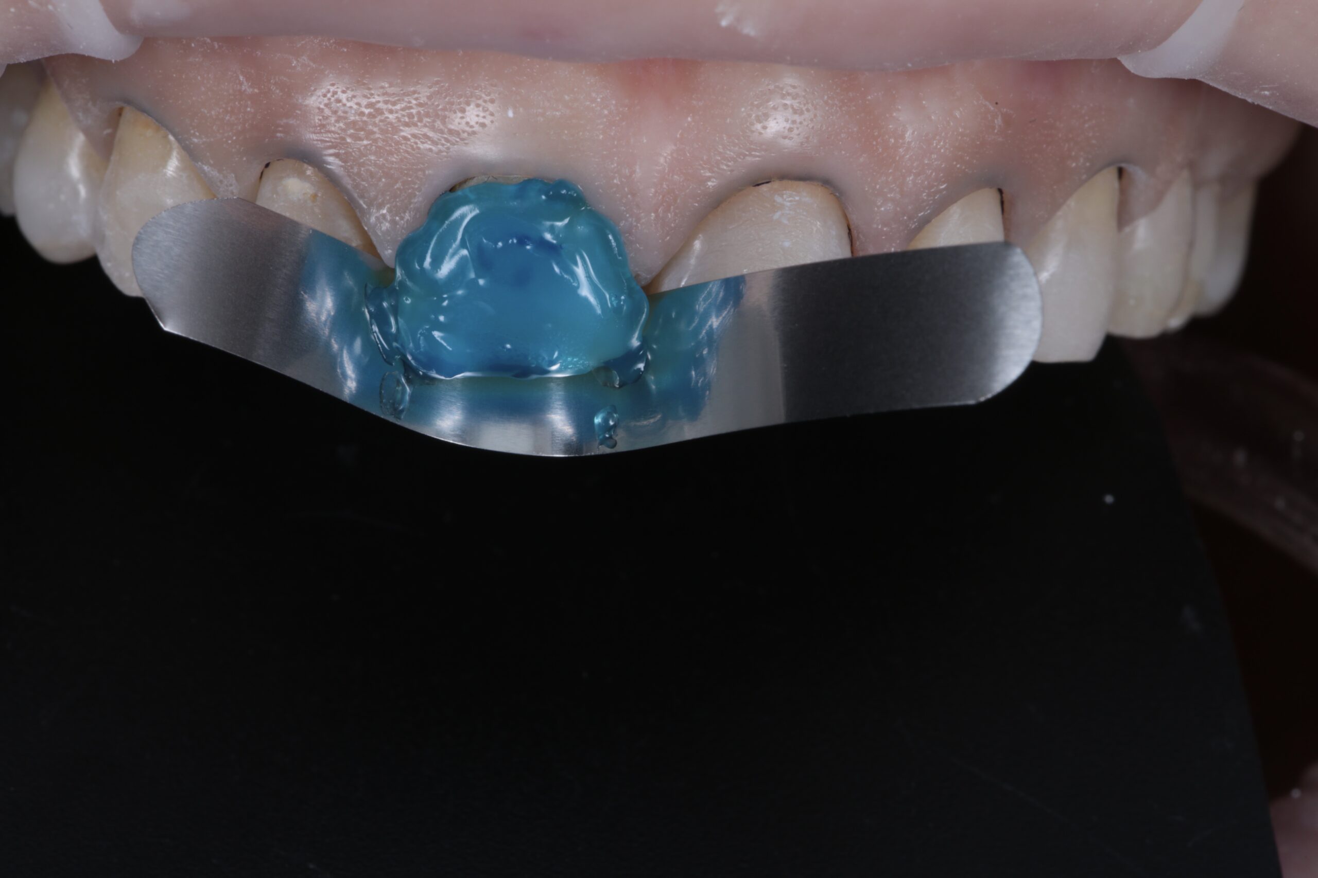 Adhesive procedure with total acid etching, as the substrate is enamel.