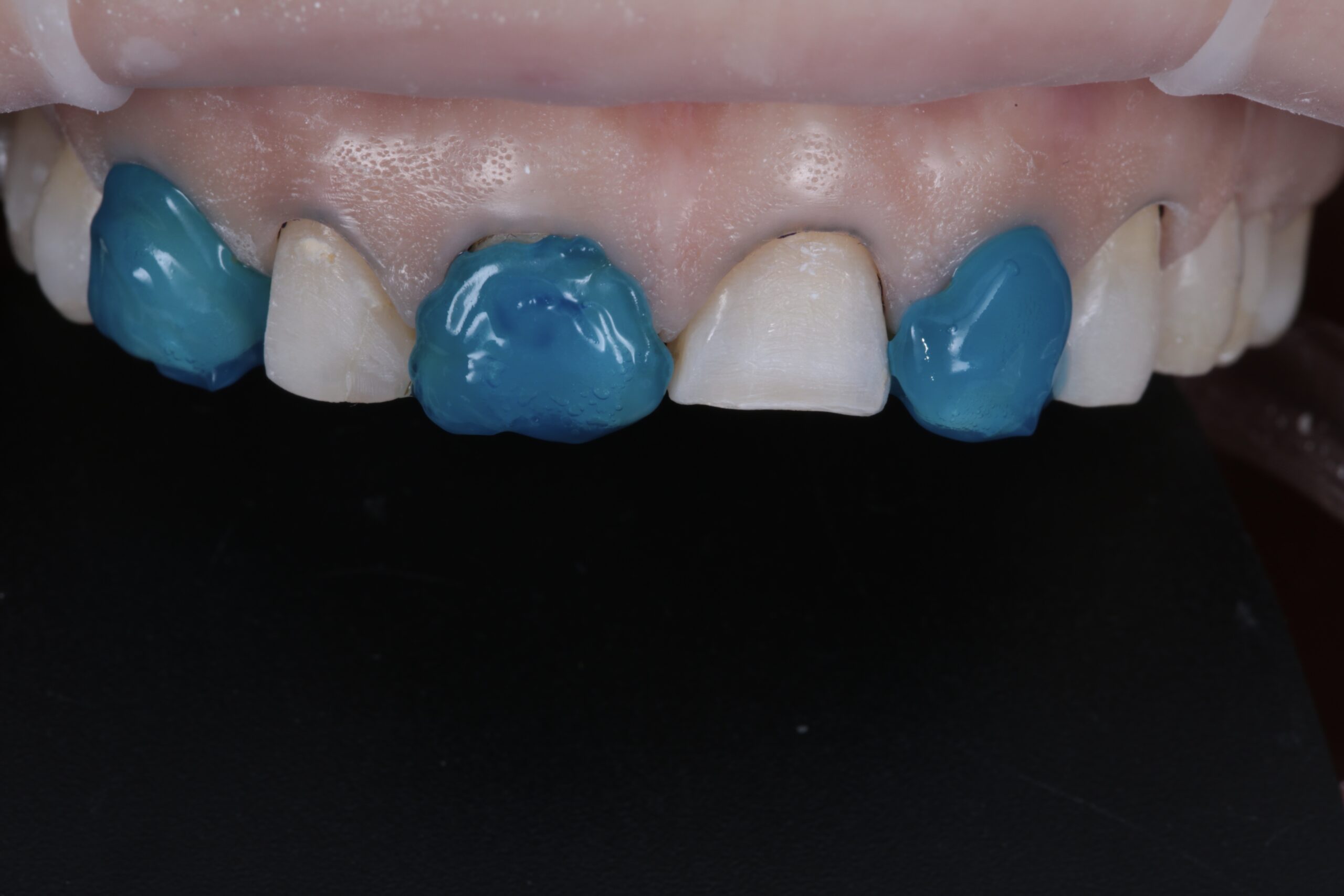 Apply phosphoric acid gel only on the teeth to be restored in the first phase (alternating teeth).