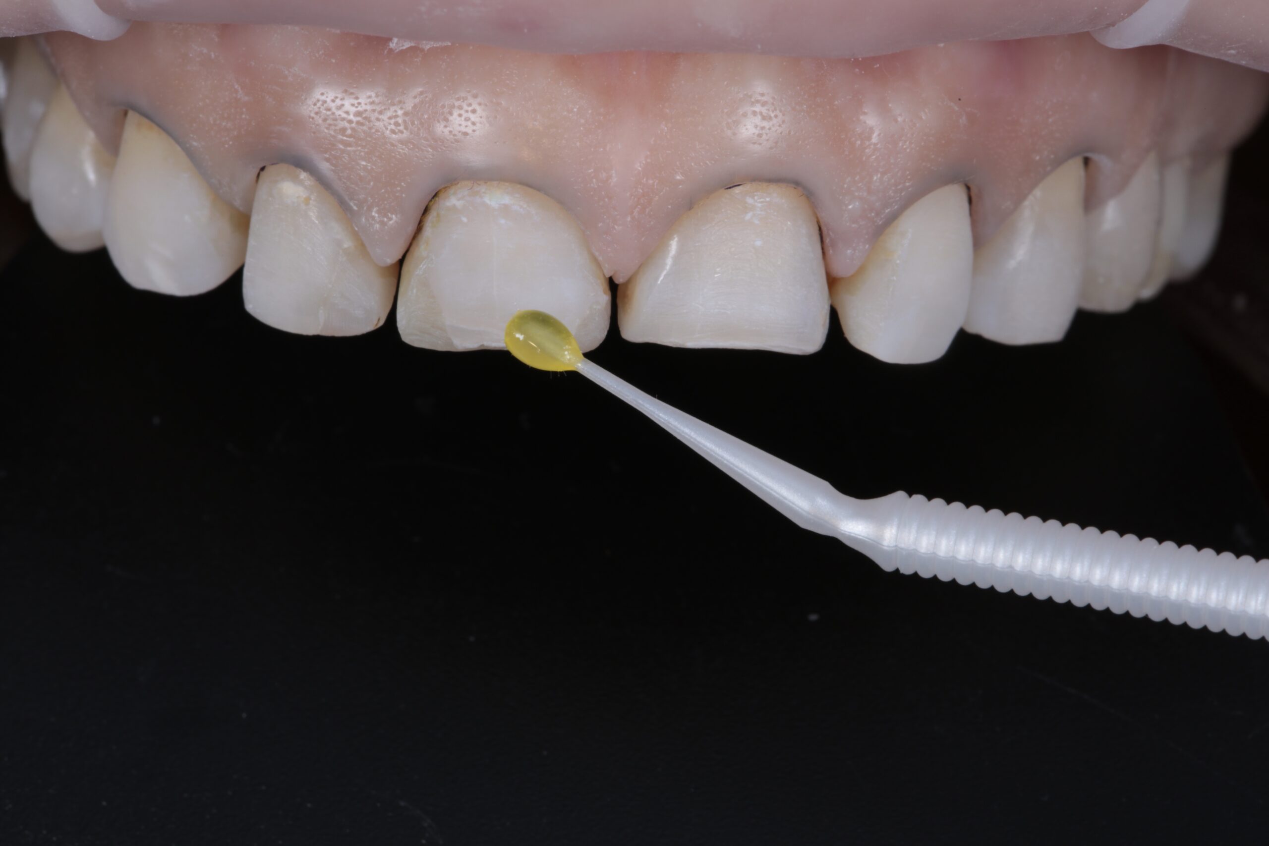 Apply a layer of 3M™ Scotchbond™ Universal Plus by rubbing the surface for 20 sec, air dry for 5 sec, and curing for 10 sec. Repeat the procedure on the teeth to be restored in the second phase.