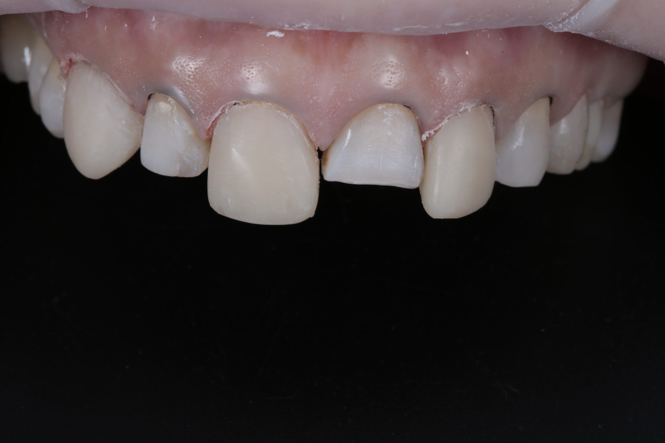 Result of the restorations from the first phase after a quick finishing.