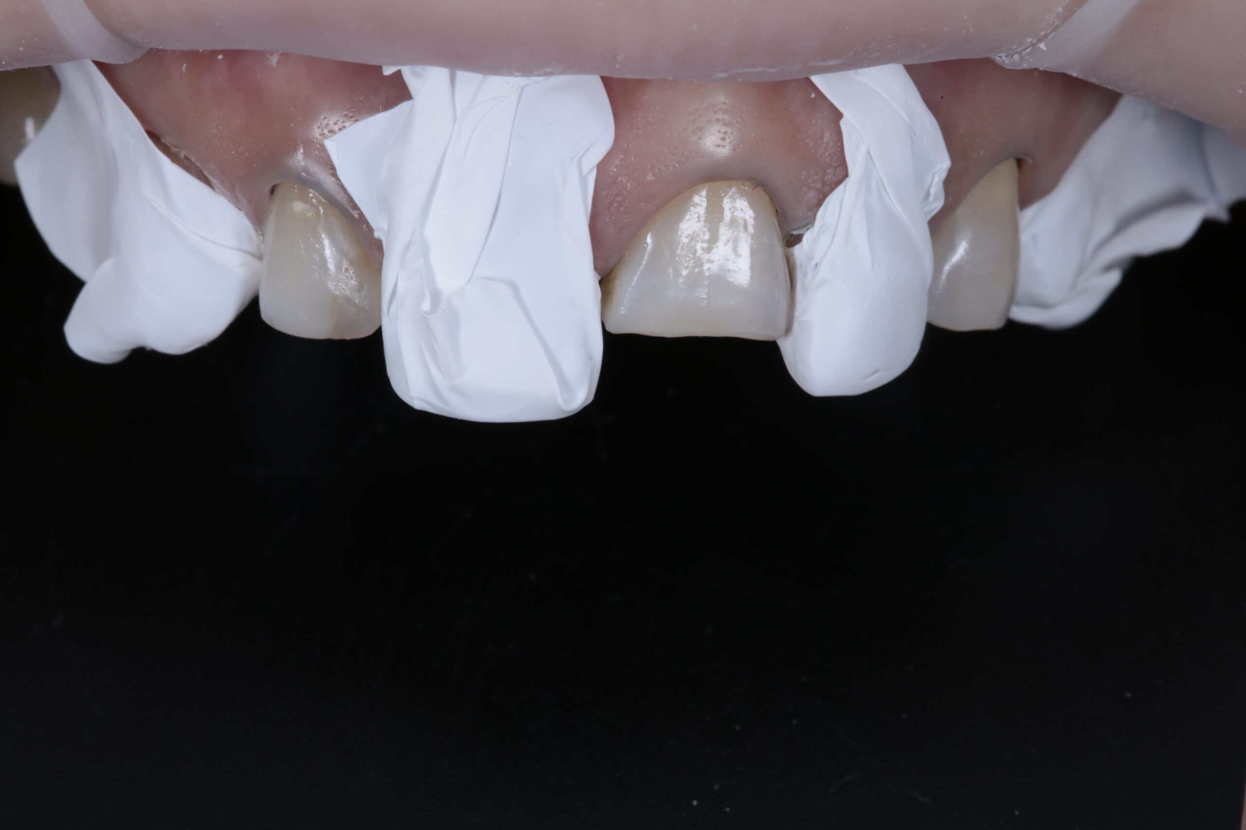 Protect the restored teeth before placing silicone key #2 to restore the teeth in the second phase. Its ease of handling and fluidity when warmed make 3M Filtek Universal Restorative the ideal material for this technique.