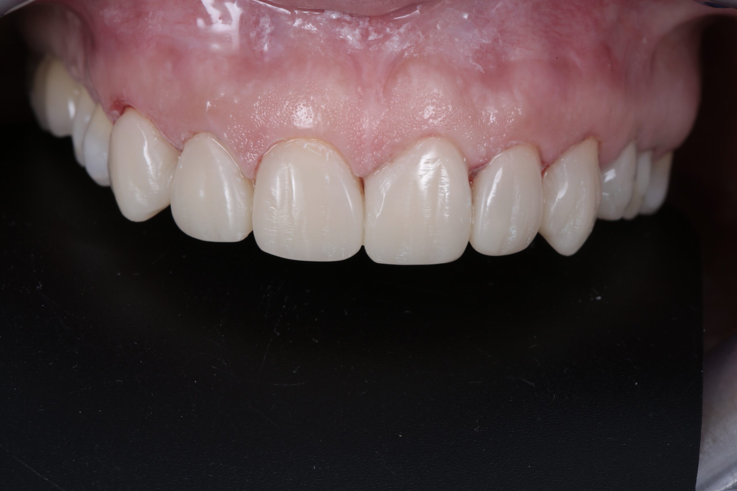 Final result after the finishing and polishing phase in a single appointment.