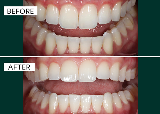 before and after