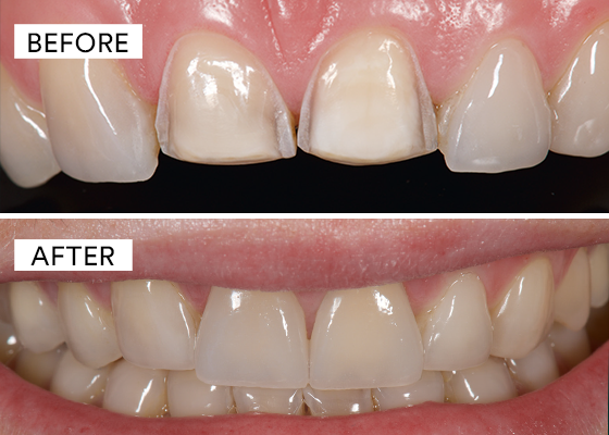 before and after