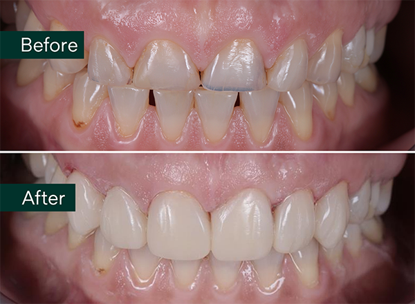 before and after