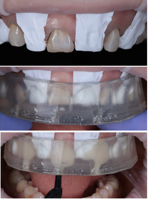 Protect the teeth that will not be restored in the first phase. Place silicone key #1 in position and hold it firmly. Inject 3M™ Filtek™ Universal capsule warmed to a maximum of 70º C. Cure each restoration for 20 sec through the silicone key and an additional 10 sec per surface after removing it.