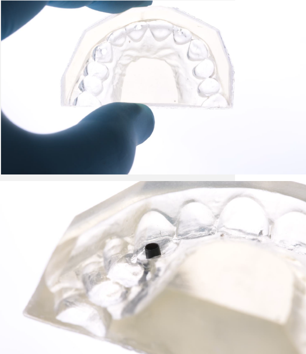Each silicone key will have a hole that matches the diameter of the capsule over the tooth to be restored. The holes should be oriented towards the palatal side so that the buccal face is not affected.