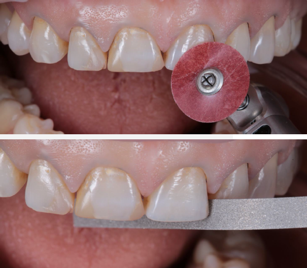 Remove the aprismatic layer of enamel with a 3M™ Sof-Lex™ coarse disc and the contact points with a metallic strip.