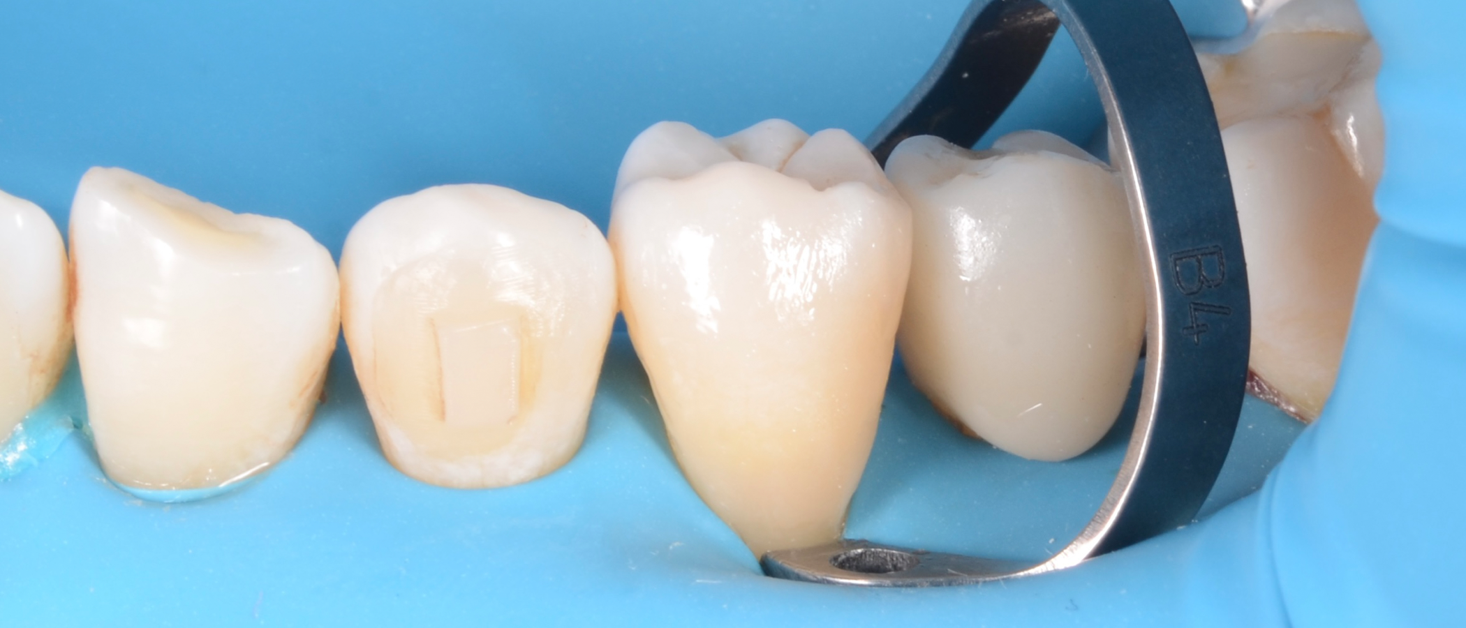 Contour before finishing and polishing. Note the smooth transition between the tooth and the restoration