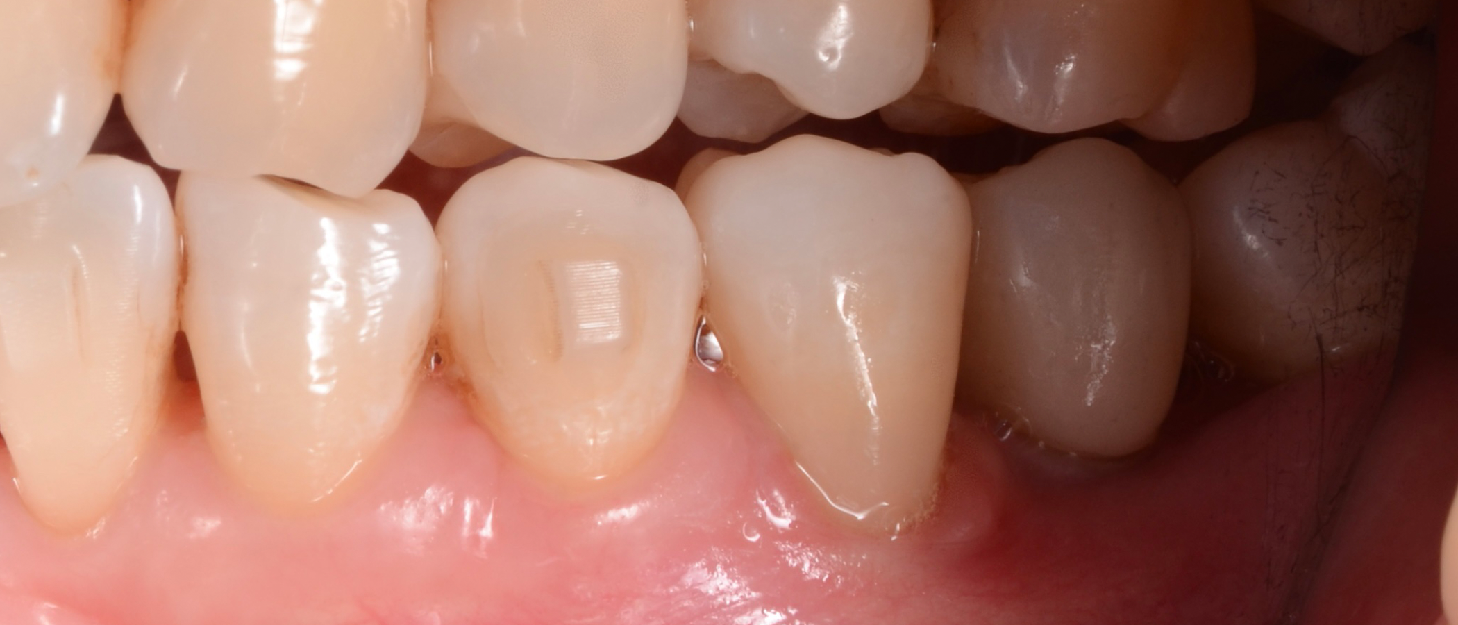 Result after removal of rubber dam. Note the smooth color blend between the restoration and the natural tooth